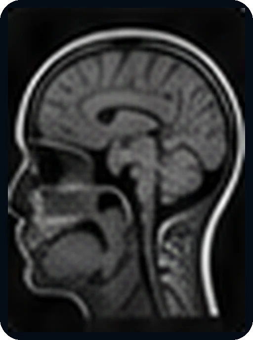 Examinare RMN cerebrală